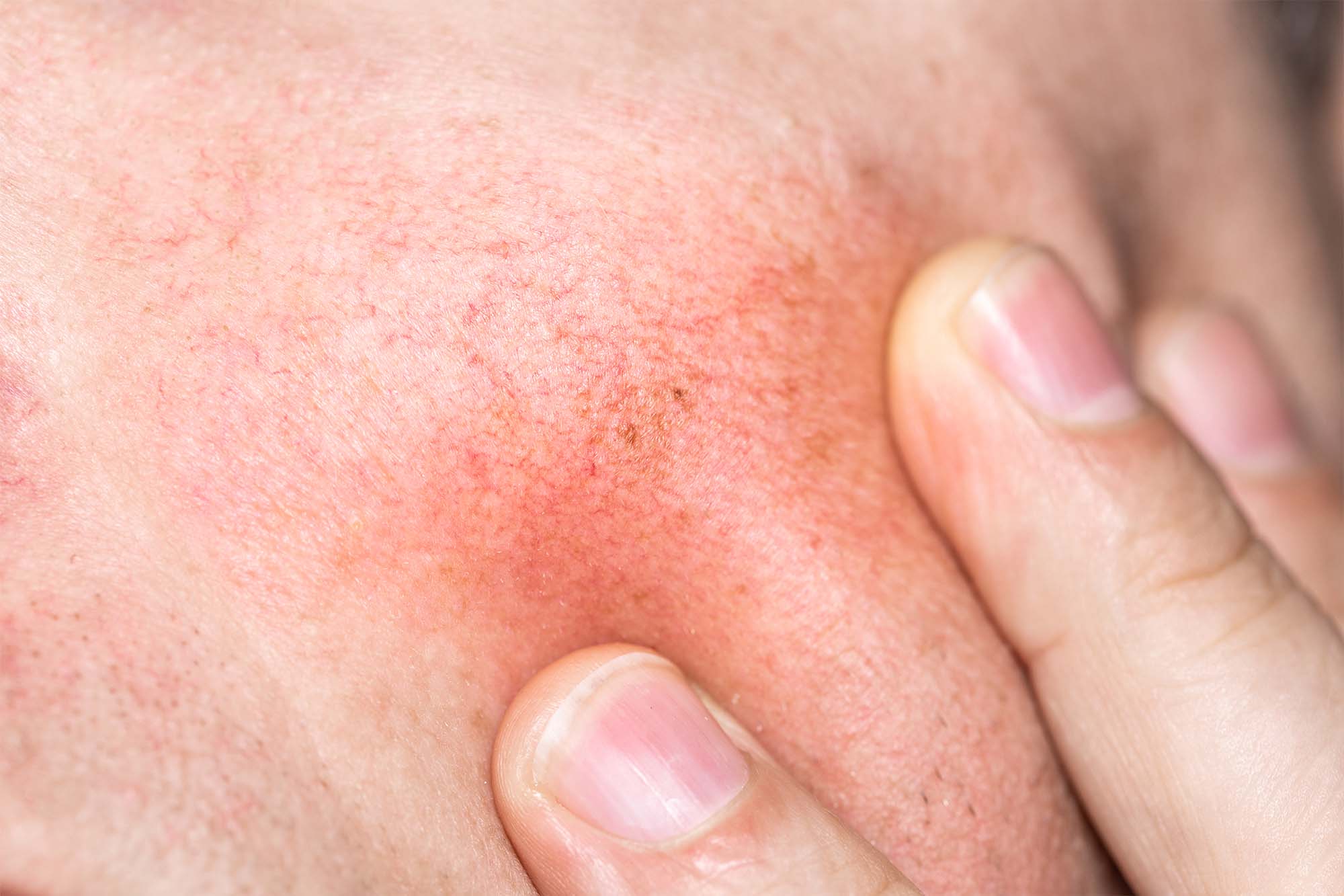 Image of Vascular Lesions & Facial Redness