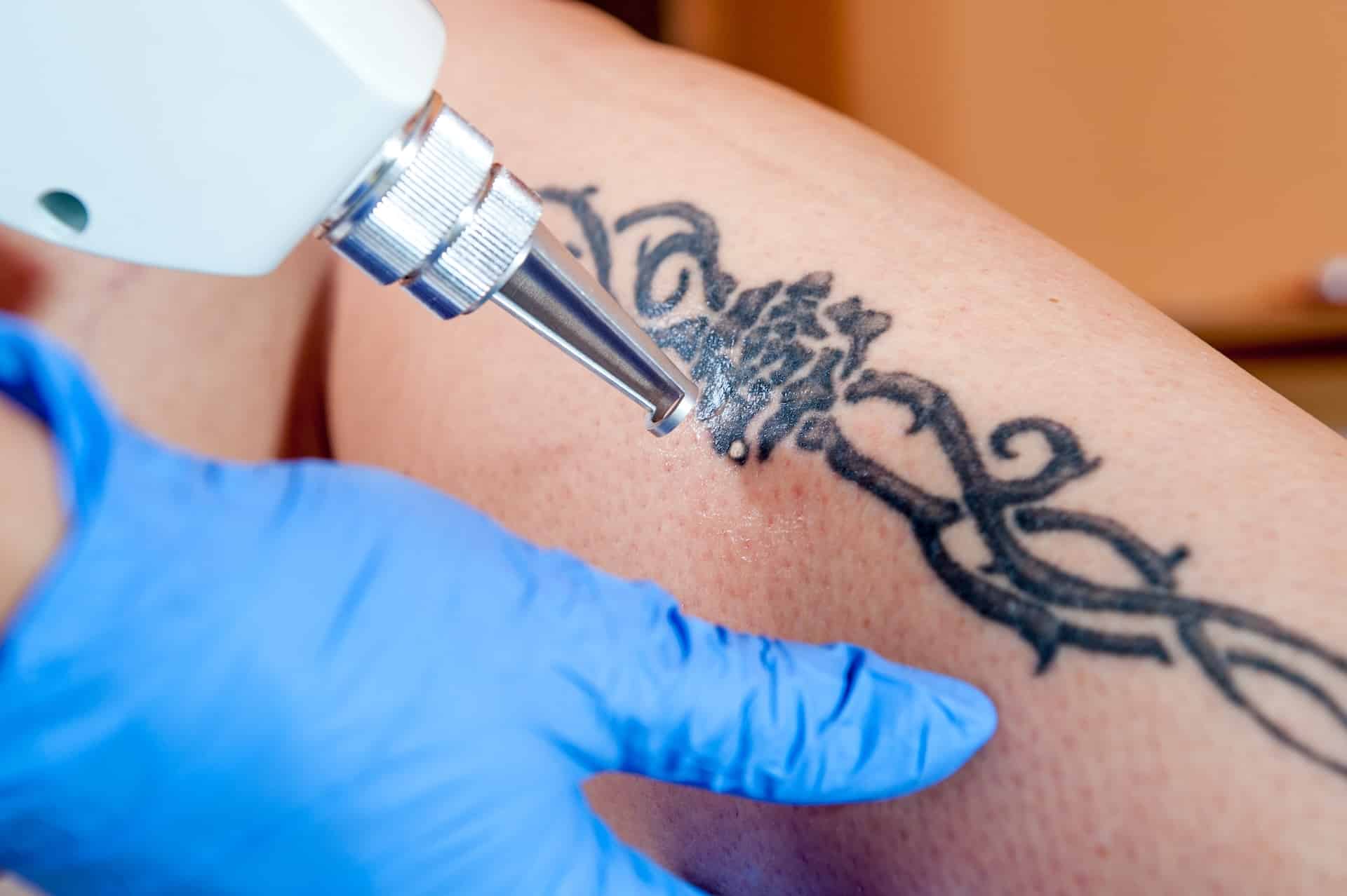 Image of Tattoo Removal