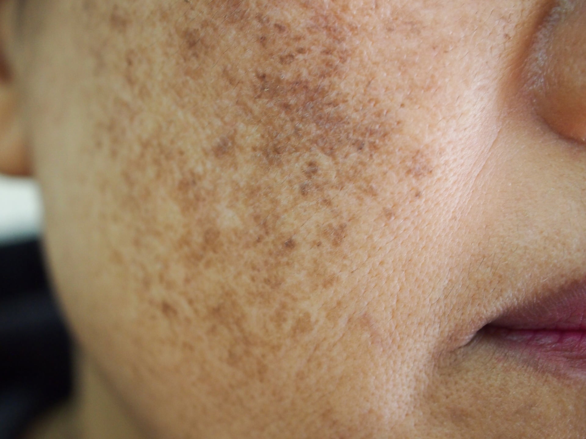 Image of Melasma