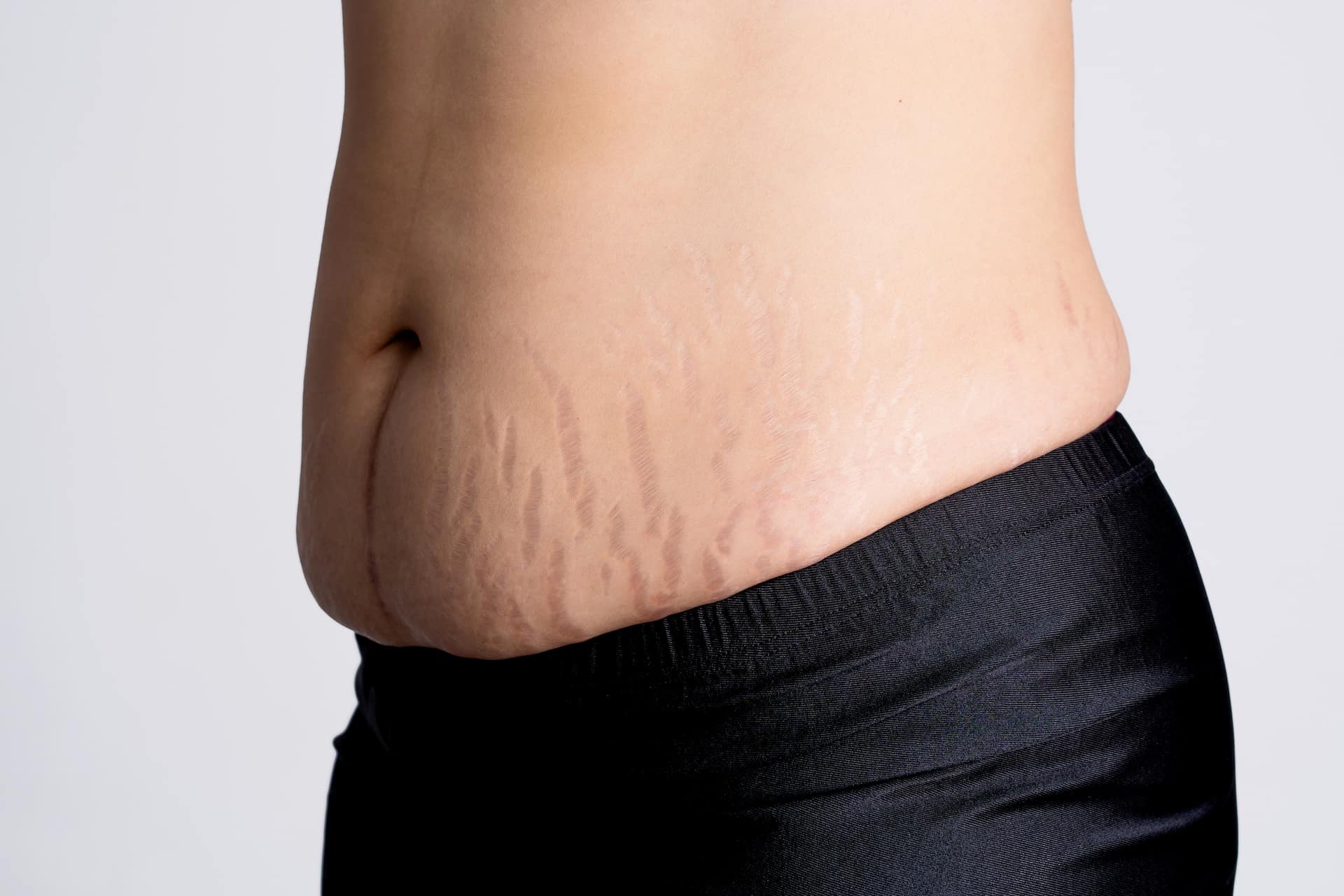 Image of Stretch Marks