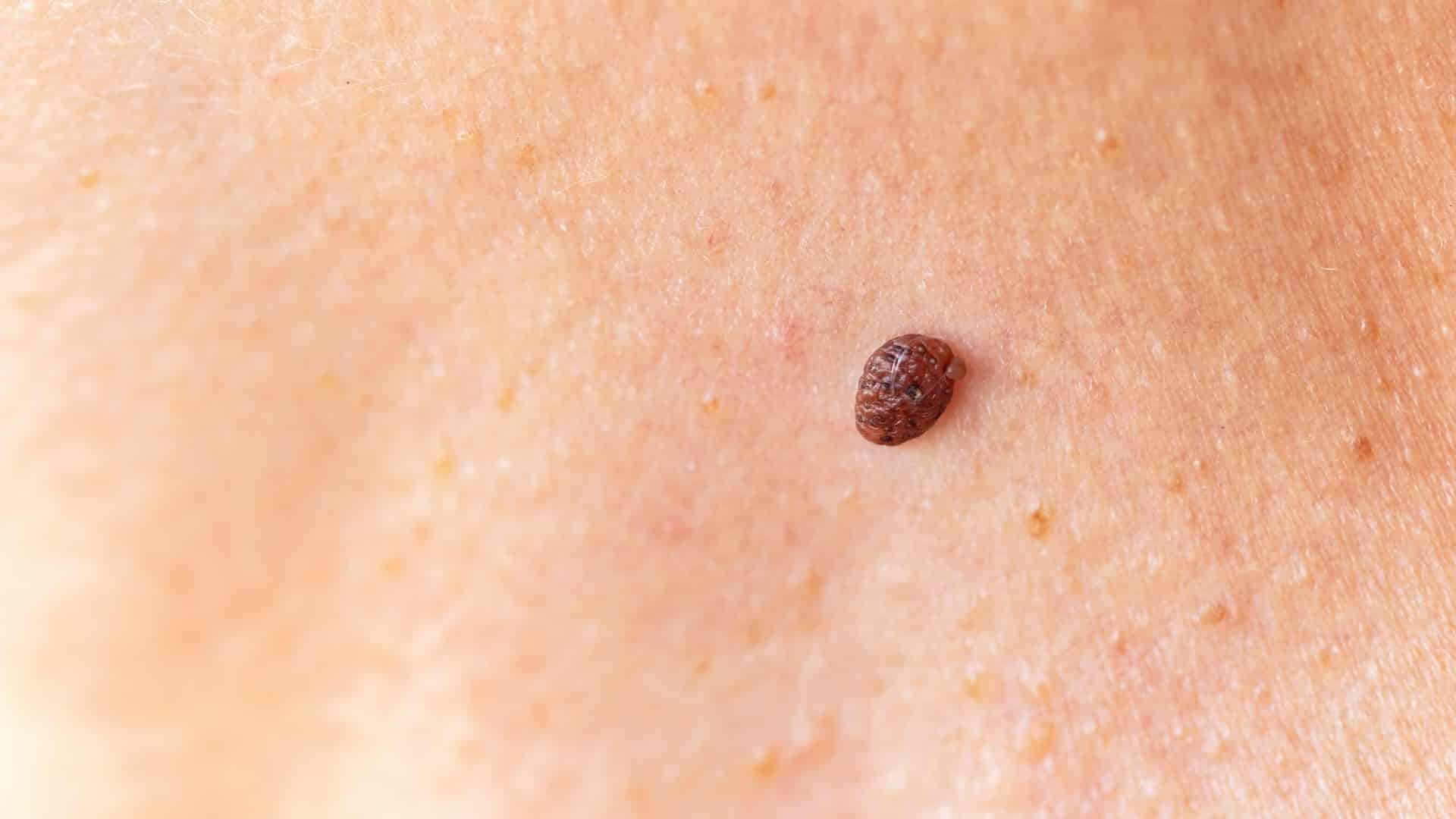 Image of Benign Skin Lesions
