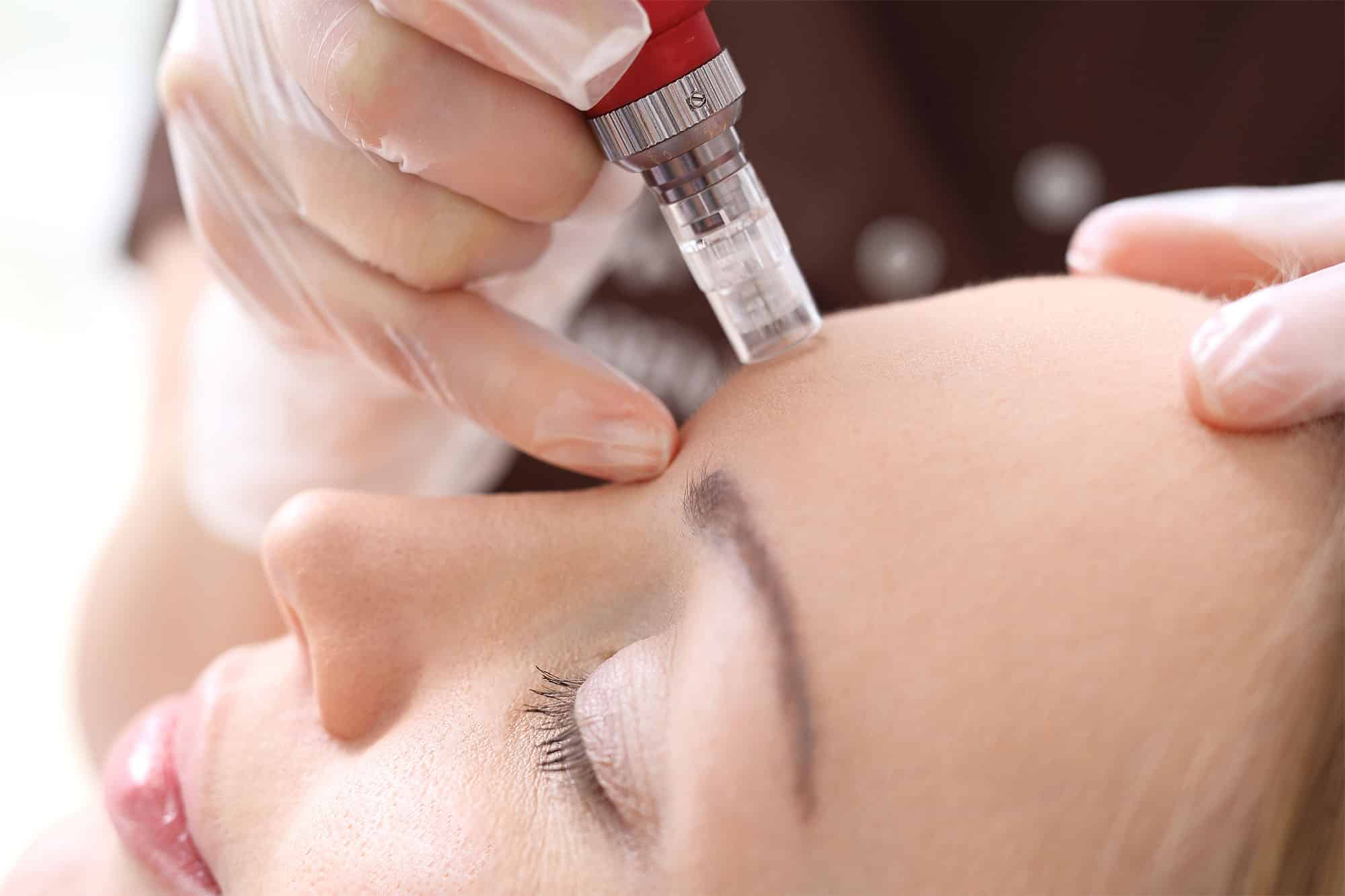 Image of Dermapen® DP4 Microneedling 