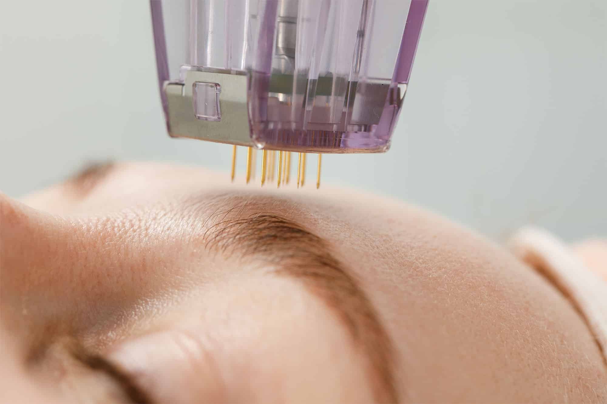 Image of Potenza™ RF Microneedling 
